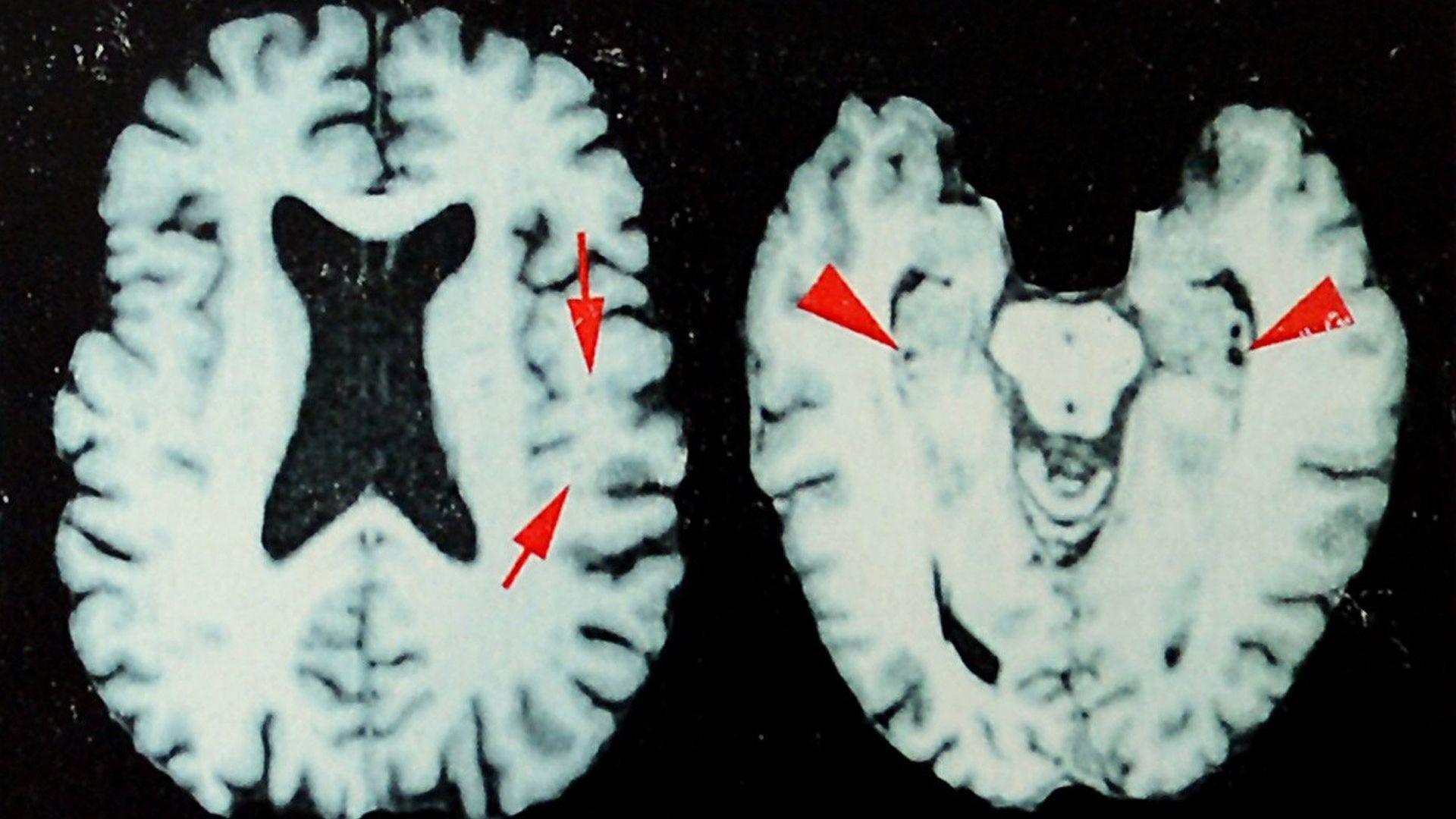 New Study Shows Up to 98% of Former NFL Players May Have Had Chronic Traumatic Encephalopathy