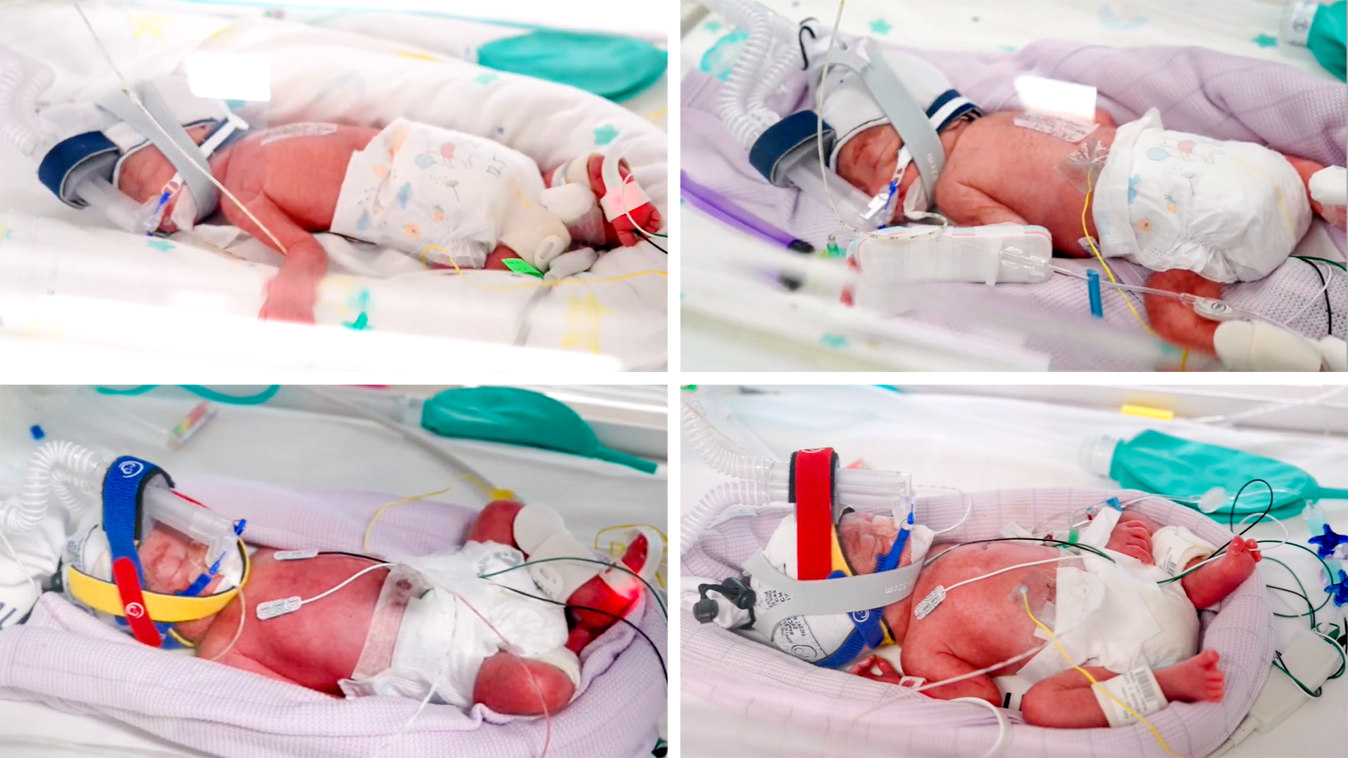 Australia’s Rare Quadruplets: A Natural Miracle at 28 Weeks